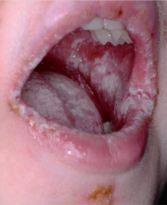 Kandidiasis Mukokutaneous