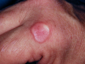 Granuloma Annulare