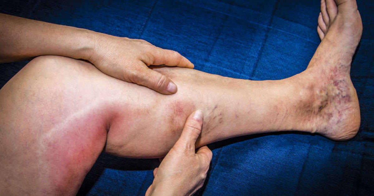 Trombosis Vena Dalam