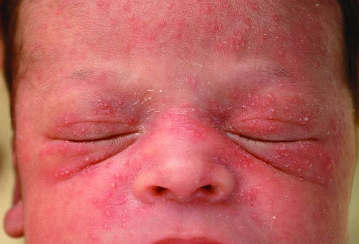 Erythema Toxicum Neonatorum