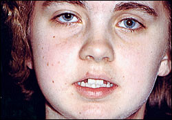 Basal Cell Nevus Syndrome