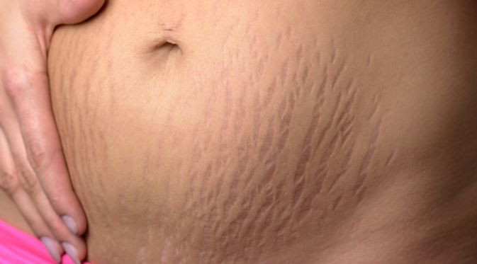 Stretch Marks
