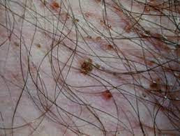 Pedikulosis pubis (kutu kelamin)