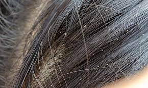 Pedikulosis Kapitis (Kutu Rambut)
