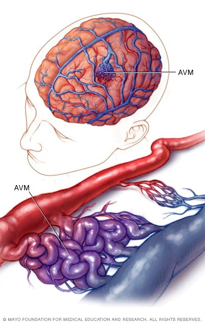 Malformasi Arteri-Vena (AVM)