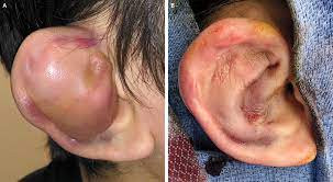 Hematoma Perikondrial