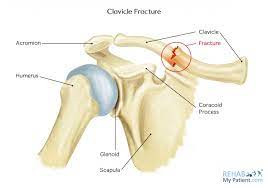 Fraktur Klavikula