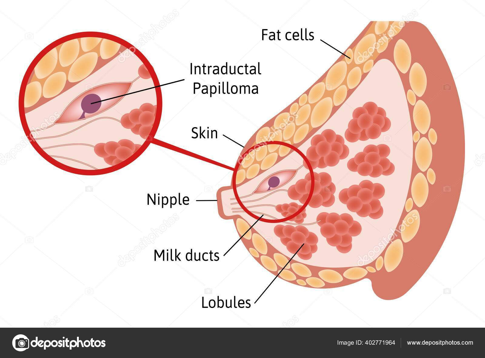Papiloma Intraduktal