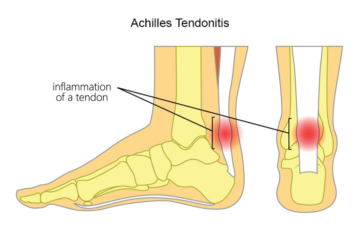 Tendinitis Achilles
