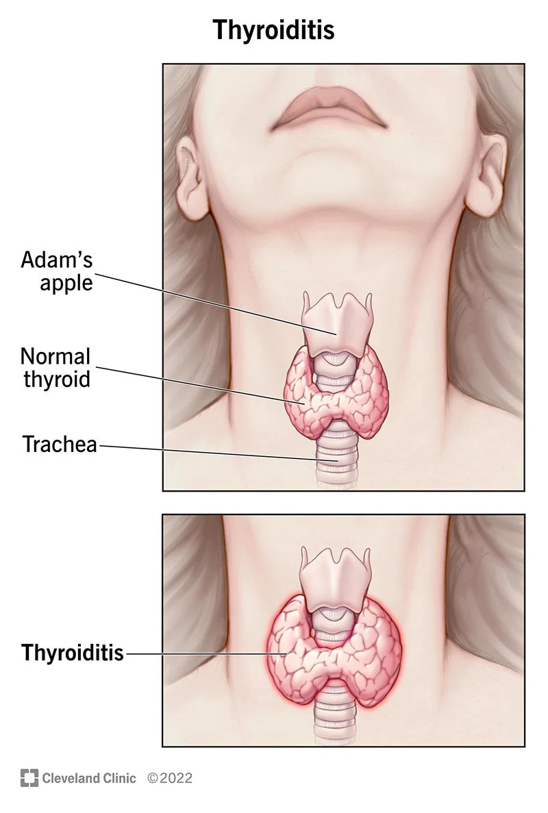 Tiroiditis