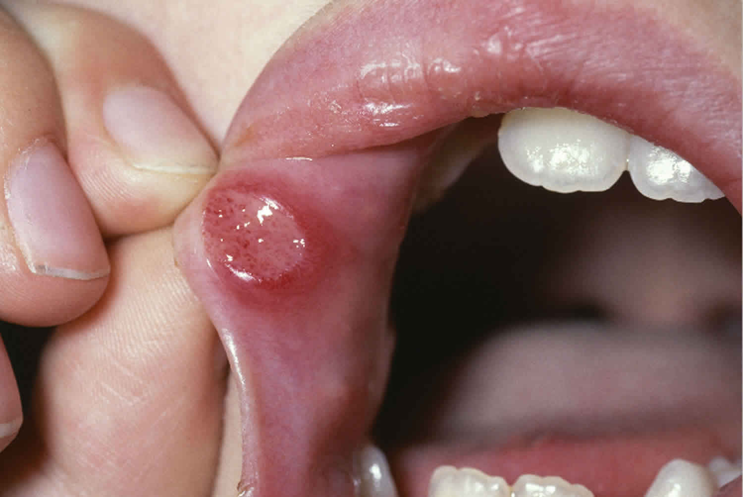 Stomatitis