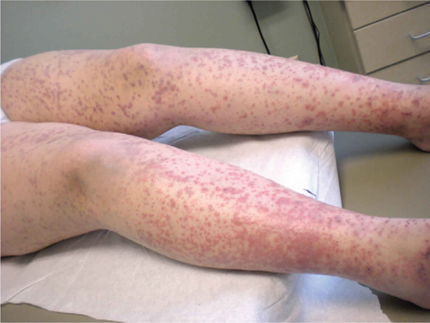 Koagulasi Intravaskular Diseminata