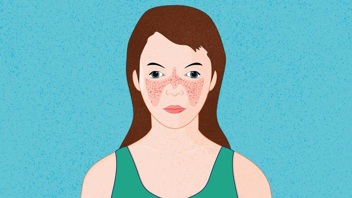 Systemic Lupus Erythematosus (SLE) pada Anak