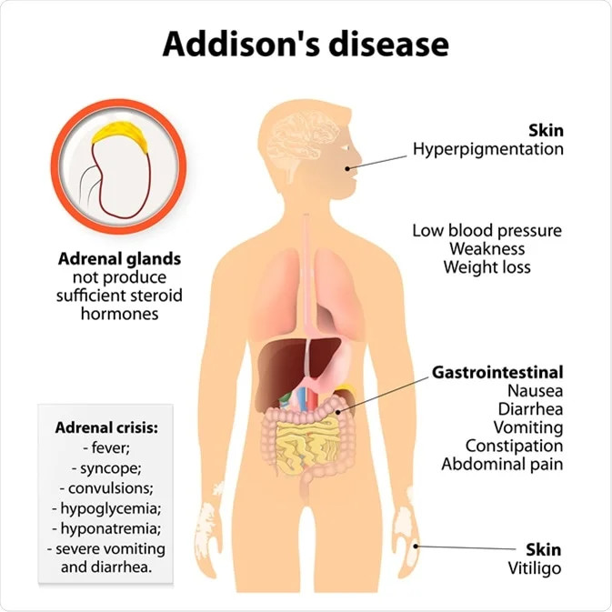 Penyakit Addison (Insufisiensi Kelenjar Adrenal Primer)