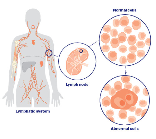 Limfoma non-Hodgkin & Hodgkin