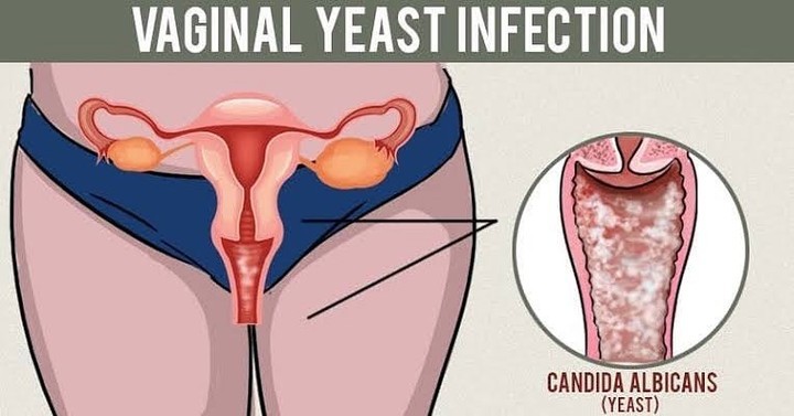 Candidiasis Vaginalis