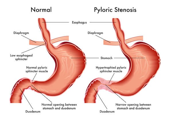Stenosis Pilorus