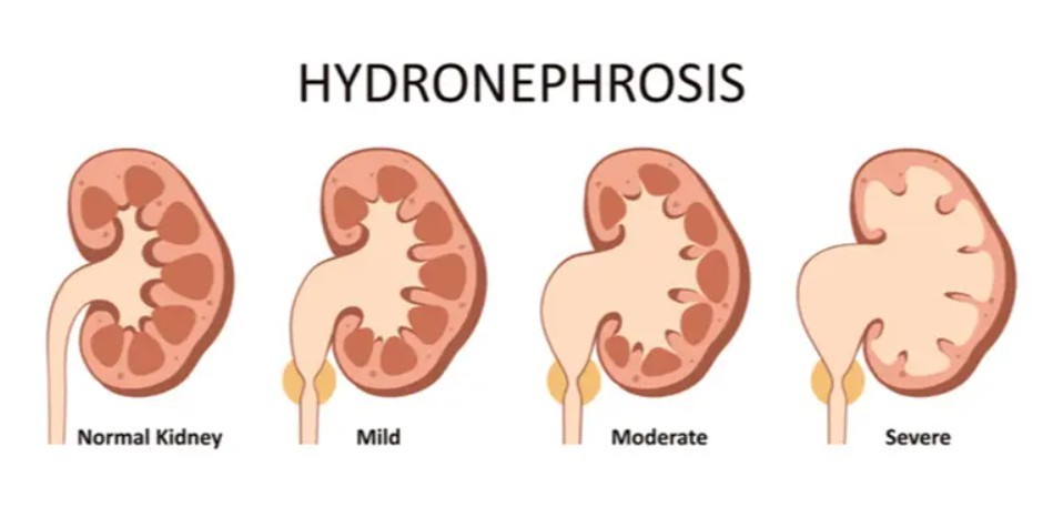 Hidronefrosis