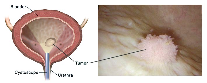 Tumor Kandung Kemih