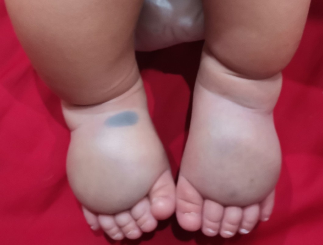 Limfedema (Primer, Sekunder) pada Anak