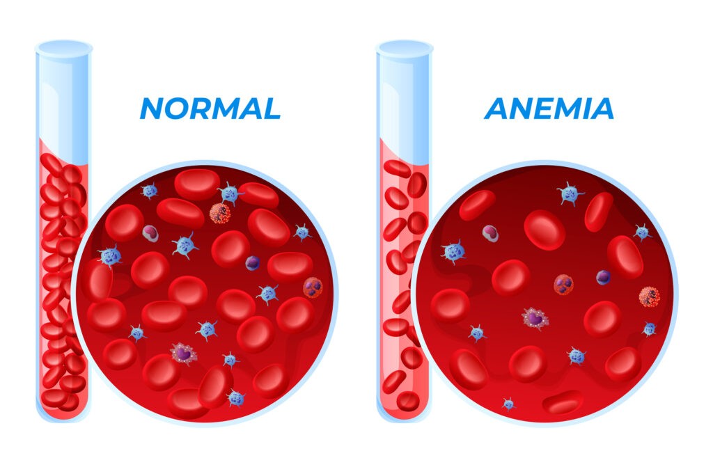 Anemia