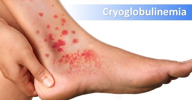 Cryoglobulinemia