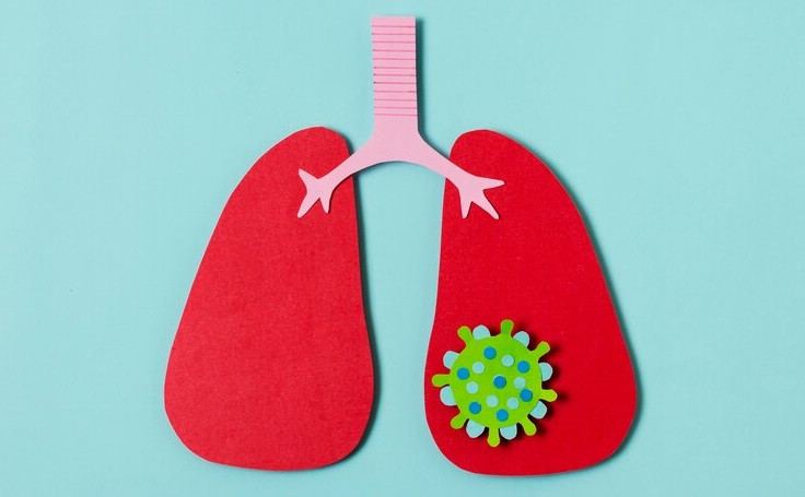 Apa itu TB Milier dan Bagaimana Gejalanya?