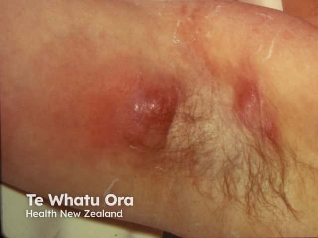 Gambar 1: Abses Kulit. Credit: dermnetnz.org