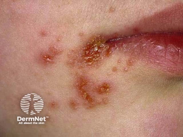 Gambar 1: Impetigo. Credit: dermnetnz