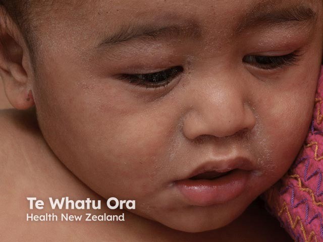 Gambar 2: Ruam campak. Credit: Dermnetnz.org