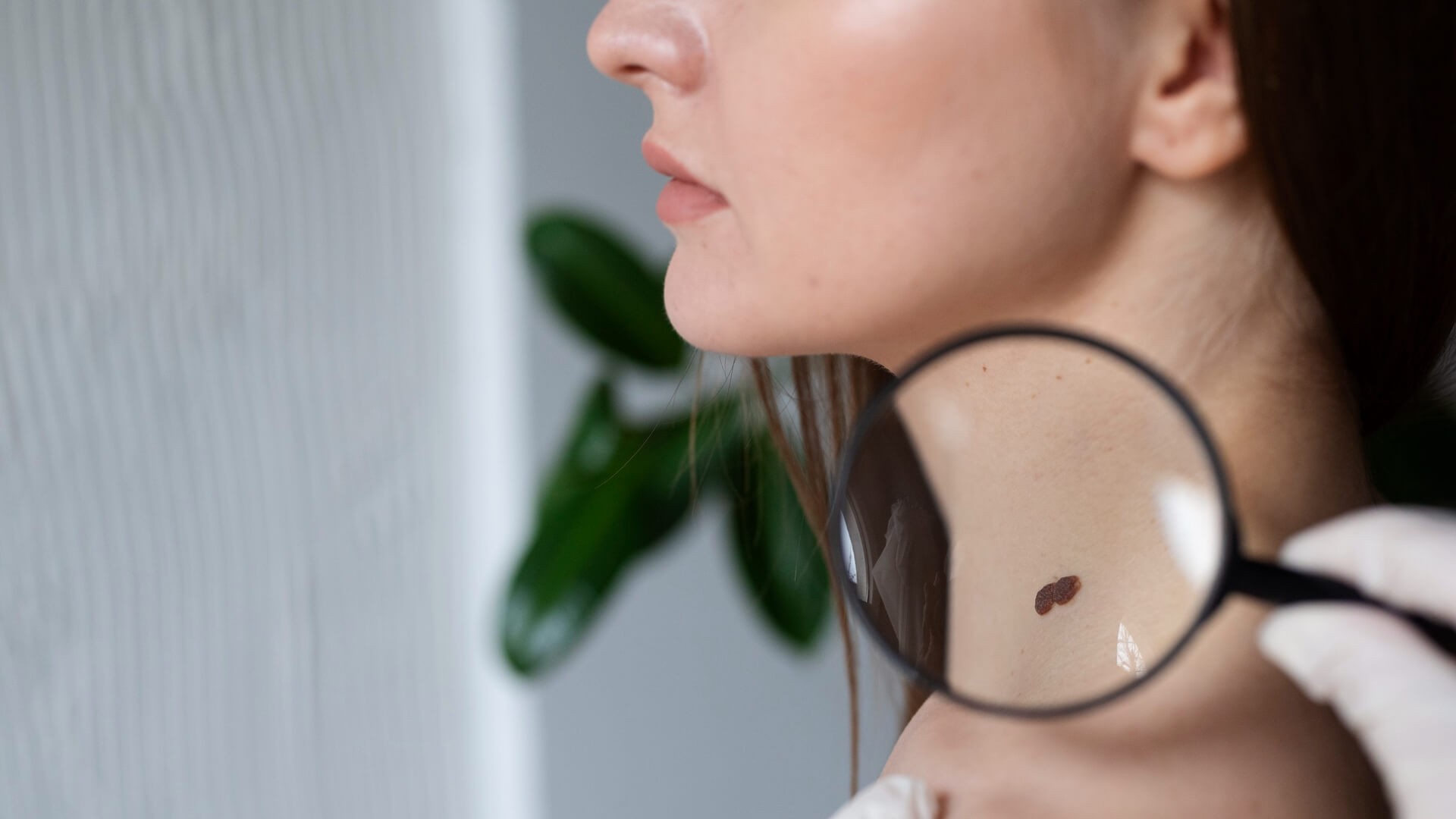 Gejala, Penyebab, dan Tingkatan Kanker Kulit Melanoma